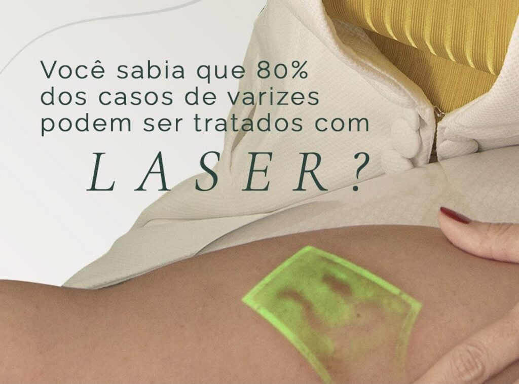 tratamento de varizes com laser
