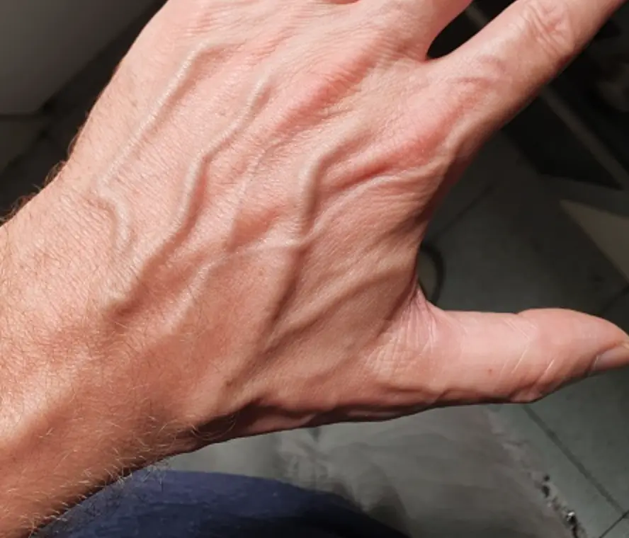 Veias dilatadas nas mãos: causas e tratamentos I Dra. Carina Brandão